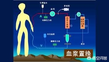 富豪与儿子置换血浆（血浆置换为什么不进入医保？）