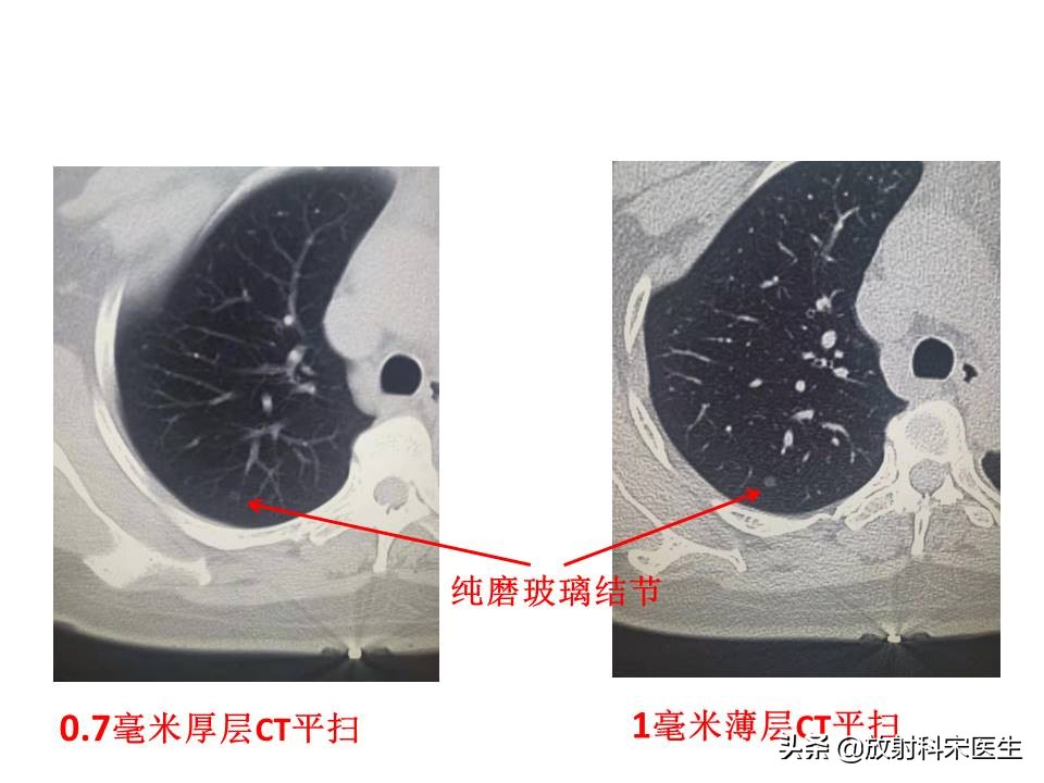 弄错CT图像致误诊（肺GGO，普通CT、HRCT常规扫描，难以去准确评价它，常有漏诊、误诊发生，怎么办？）