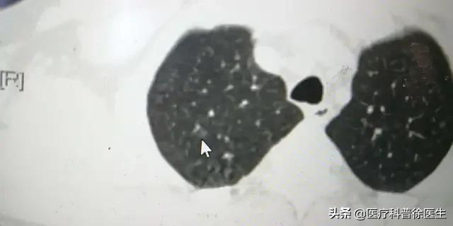 肺部CT平扫检查准确吗？：弄错CT图像致误诊