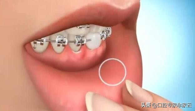 牙套的寿命？：戴牙套5年坏了8颗牙