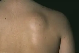 为什么身上总长脂肪瘤？医生提醒：3个诱因，要及时避免图片