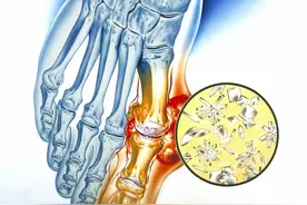 痛风不能吃豆制品？专家辟谣：这是错误的说法，一文给大家说清楚图片