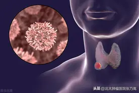 甲状腺癌来临时并不难发现，只是被你忽视了而已图片