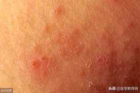 夏天9种常见皮肤病的病因、症状汇总及治疗方案图片
