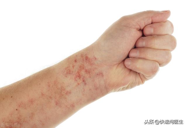 手臂上有很多小红点,怎么办?（手臂上的小红点是什么可能是以下3个原因）