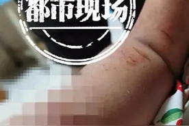 3岁女童摔了一跤，结果血管肌腱全断了，当时手上拿了一瓶牛奶图片