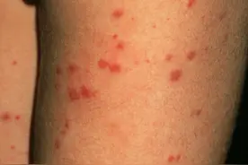 医生说：皮肤粘膜出血不得不说的事图片