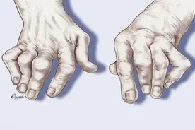 尿酸高长出痛风石，还能逆转消失吗？专家：符合2个条件就可以图片