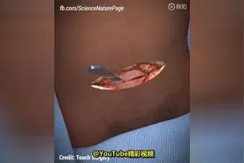 3D动画演示女人剖腹产全过程，每一个妈妈都是勇士视频封面