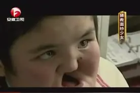 花季少女患罕见疾病面容丑陋 脸上竟形成个大洞