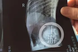 天！绣花针藏女孩胸壁两年，取出已生锈图片