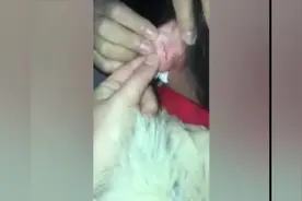 一年级女孩未完成作业被老师扭伤耳朵，官方：指甲划的