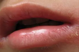 烂嘴角“好好吃饭”来解决，大可不必吃药！图片