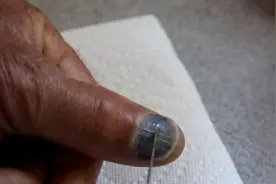 嫌“指甲瘀血”烦，所以他的处理方式让大家看得瞠目结舌！慎入图片