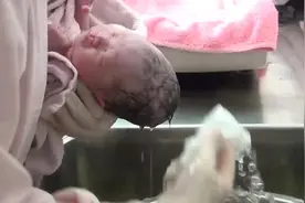 顺产宝宝从产房抱出来洗头，头部明显受挤压变形，医生说很快恢复