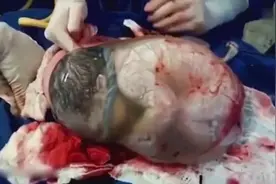 厉害了我的宝：婴儿出生时羊水未破 被羊膜囊完整包裹视频封面