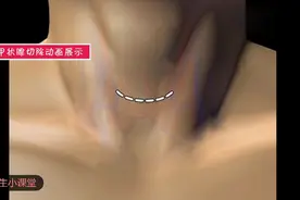脖子大有可能是甲状腺癌，3D动画演示甲状腺是如何切除的视频封面