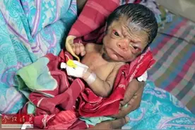 新生儿长满皱纹似老人 父母高兴称“奇迹”图片