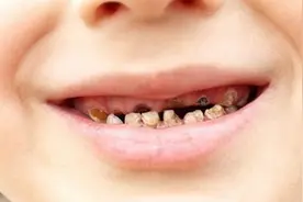 小儿“烂牙”不及时处理或可诱发气管炎图片