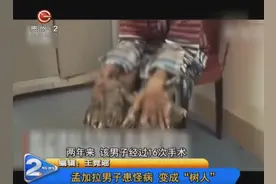 孟加拉男子患怪病，变成“树人”视频封面
