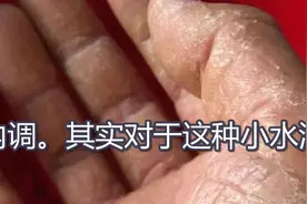 手脚总是出现小水泡，还很痒，或许是这里出了问题，别不当回事！