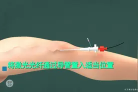 3D动画静脉曲张微创手术，无疤痕，只需要一个小口视频封面