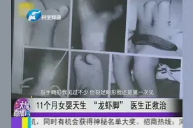 11个月女婴天生“龙虾脚” 医生正救治视频封面