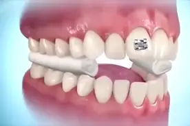 知道牙齿矫正术后牙箍为什么带上不会掉吗？3D演示其原因