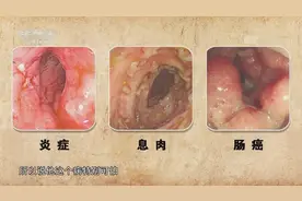 溃疡性结肠炎很危险！专家现场讲解，长期炎症变癌症的几率非常高