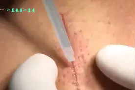 老外发明伤口愈合“胶水”，涂上60秒伤口就能愈合，不留任何伤视频封面