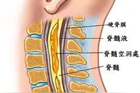 脊髓空洞症的科学护理有助于康复图片