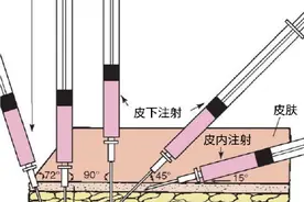 护士必学十种静脉穿刺新方法，太全了！图片