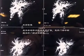 第八一医院完成首例高难度肝门胆管癌手术图片