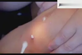 液氮冷冻治疗寻常疣（瘊子），一位勇敢的小患者