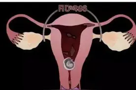 四种堕胎手术 医生看了都受不了图片