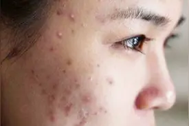 夏天脸上长痘痘，居然和脾胃不好没关系，而是这些螨虫惹的祸！