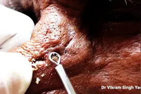 一下挤出这么多黑头，太爽了！老人鼻子上的黑头，一挤一大片！图片