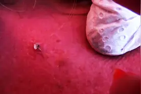 老爸帮老妈挤后背的黑头，挤出后惊了一下，太大了，看着莫名的爽图片