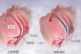 打鼾者福音——云中飞止鼾器图片