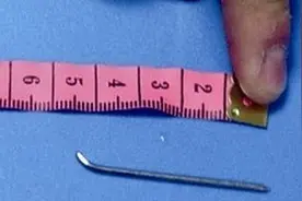癫痫真凶：寄宿脑内40年的钢钉图片