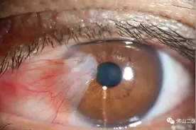 「科普」眼睛长了赘生物，它是什么？要治疗吗？图片