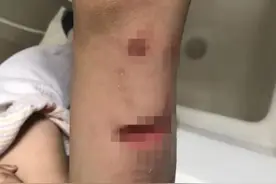湖南耒阳通报两恶狗撕咬小孩老人：小孩伤重，正在查找狗主人图片
