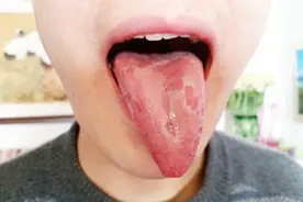 吃烫饭、喝开水舌头被烫了怎么办呢？