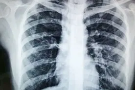 肺结核患者生活中要注意这几方面 能帮助病情恢复视频封面