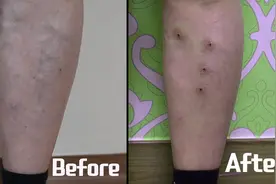 外国医生用蚂蟥治疗静脉曲张 不用手术 吸出淤血 效果惊人视频封面