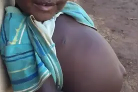 非洲小朋友肚大如鼓肚脐外翻 是不是得了什么怪病 看着都可怜视频封面