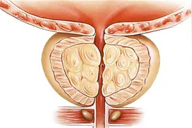 尿结石的治疗方法有哪些图片