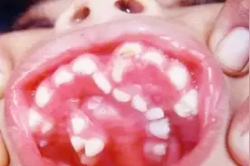 宝宝夜里咯咯磨牙好几年，粗心家长一直没发现是这个原因视频封面