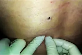 挤掉后背的大黑头，突然感到神清气爽！图片