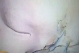 6岁男童玩剪刀一跤摔下插入头部图片